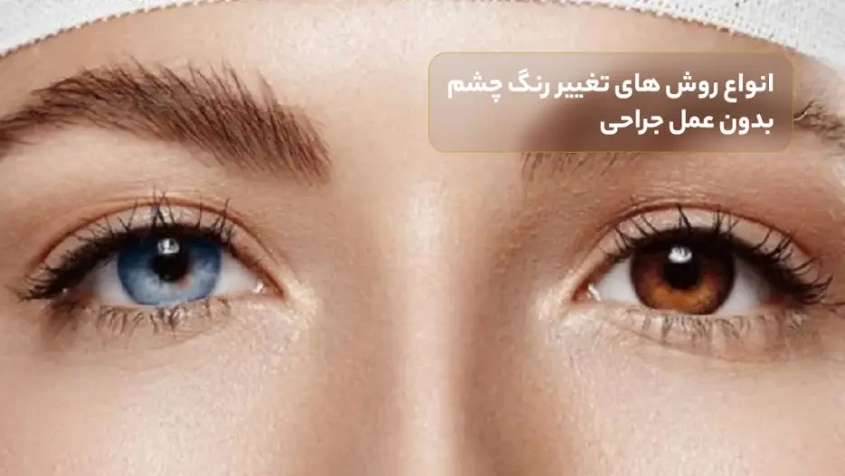 انواع روش های تغییر رنگ چشم بدون عمل جراحی