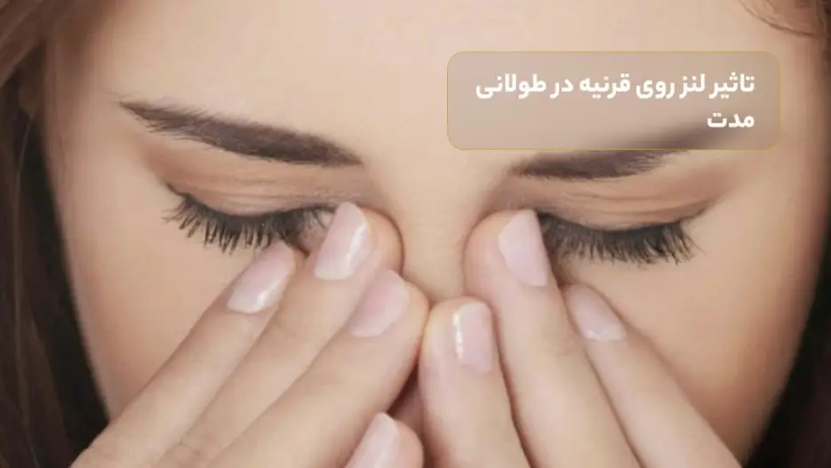 تاثیر لنز بر قرنیه در طولانی مدت